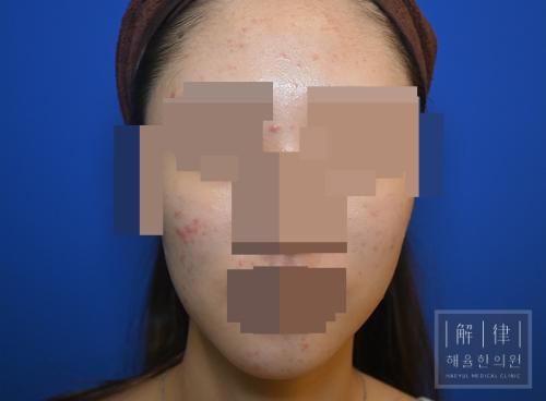 [목동점] 얼굴화농성여드름 치료사례 - 해율한의원
